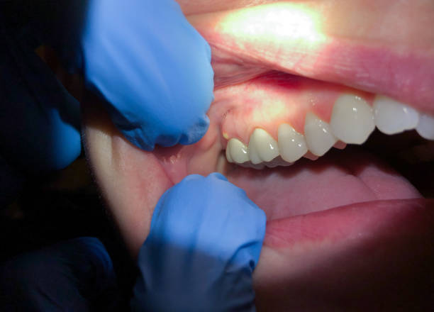 Best Dentist for Tooth Abscess  in Strum, WI